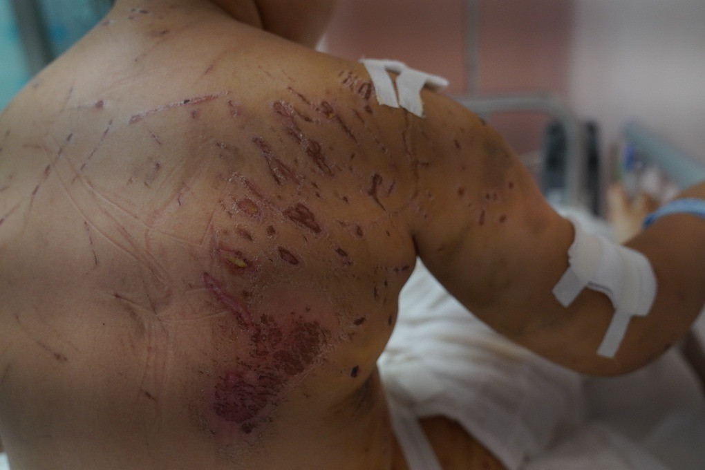 Toàn thân bé gái chi chít các vết cào do bị 4 con chó tấn công (Ảnh: T.G).