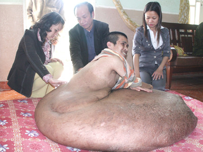 Anh Hải mang khối u dị dạng khổng lồ. Anh Hải mang khối u dị dạng khổng lồ