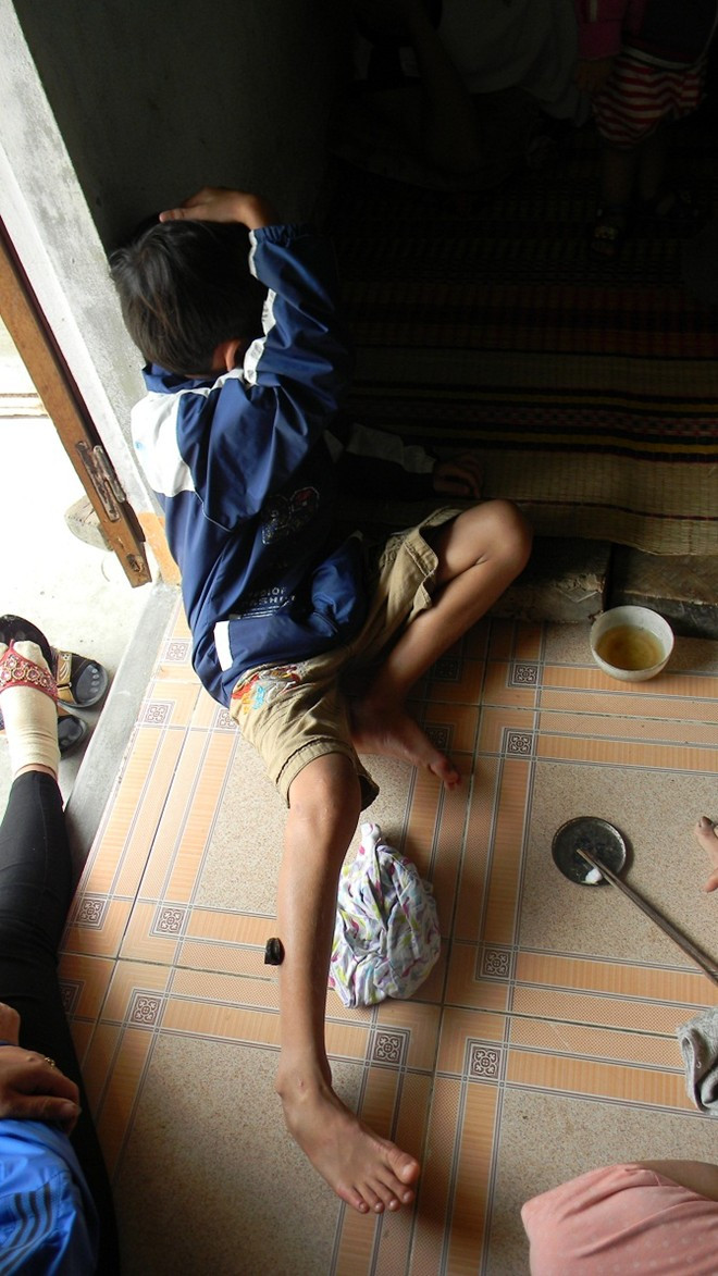 "Khắc tinh" của rắn độc đang chữa trị cho cháu Vỹ. "Khắc tinh" của rắn độc đang chữa trị cho cháu Vỹ.