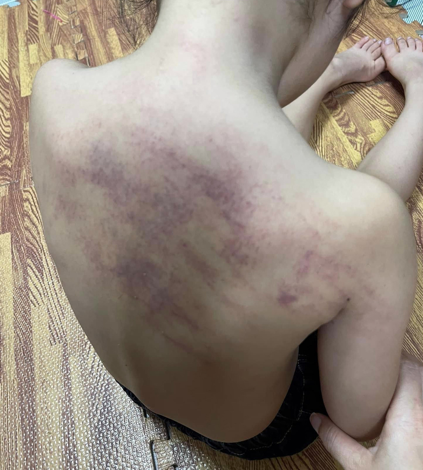 Bé N.H.N (5 tuổi) có nhiều vết bầm tím khắp lưng sau khi tan lớp về nhà. Ảnh: Gia đình cung cấp Bé N.H.N (5 tuổi) có nhiều vết bầm tím khắp lưng sau khi tan lớp về nhà. Ảnh: Gia đình cung cấp