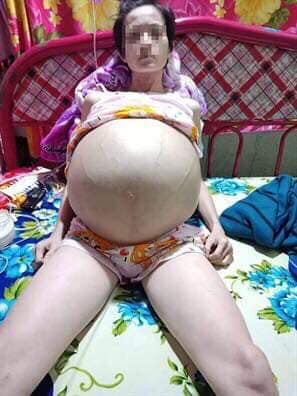 Choáng với khối u khủng nặng 25 kg trong ổ bụng bệnh nhân ảnh 2