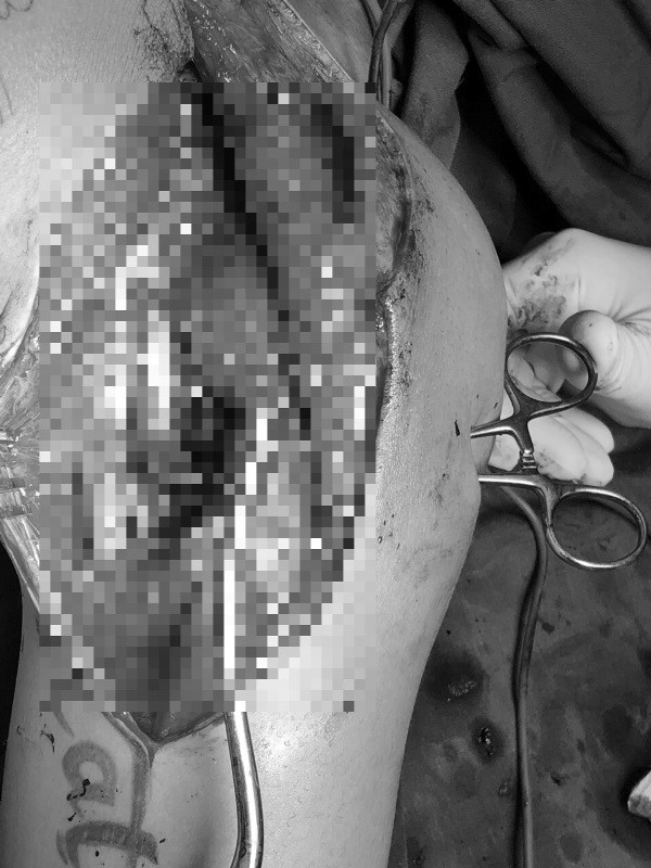 Xô xát với người lạ, nam thanh niên bị phóng dao thấu vai ảnh 2