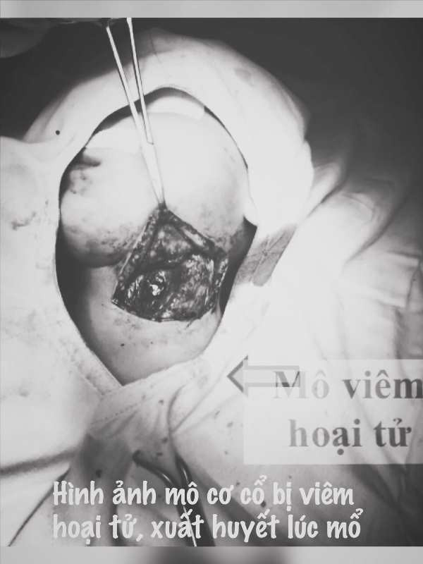 Ăn cháo cá lóc, bé gái 11 tháng tuổi suýt chết vì bị hóc xương ảnh 2