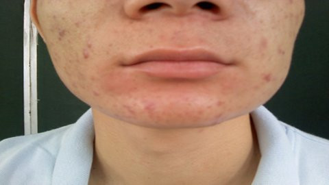 Mặt bệnh nhân bị bạnh ra vì giun gây áp xe