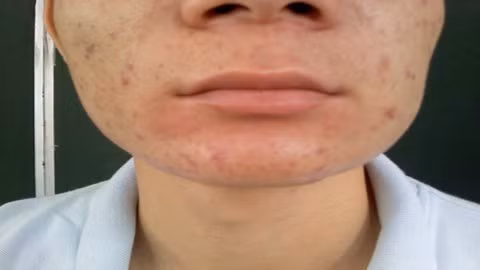 Mặt bệnh nhân bị bạnh ra vì giun gây áp xe