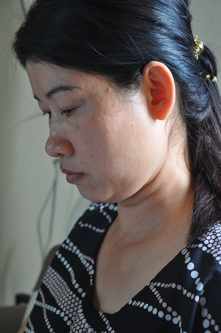 Cô bé lớp 5 có cột sống cong hình chữ... S ảnh 6