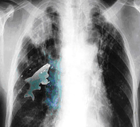 Con cá trong phổi Anil (Ảnh: The Sun)