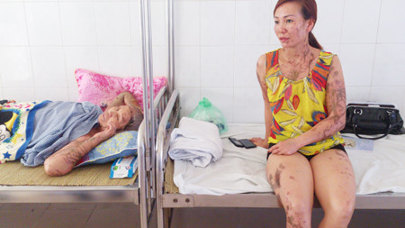 Bà Lê Thị Lý và chị Nguyễn Thị Thanh Hương điều trị tại Khoa Bỏng người lớn. Ảnh: Tuấn Nguyễn