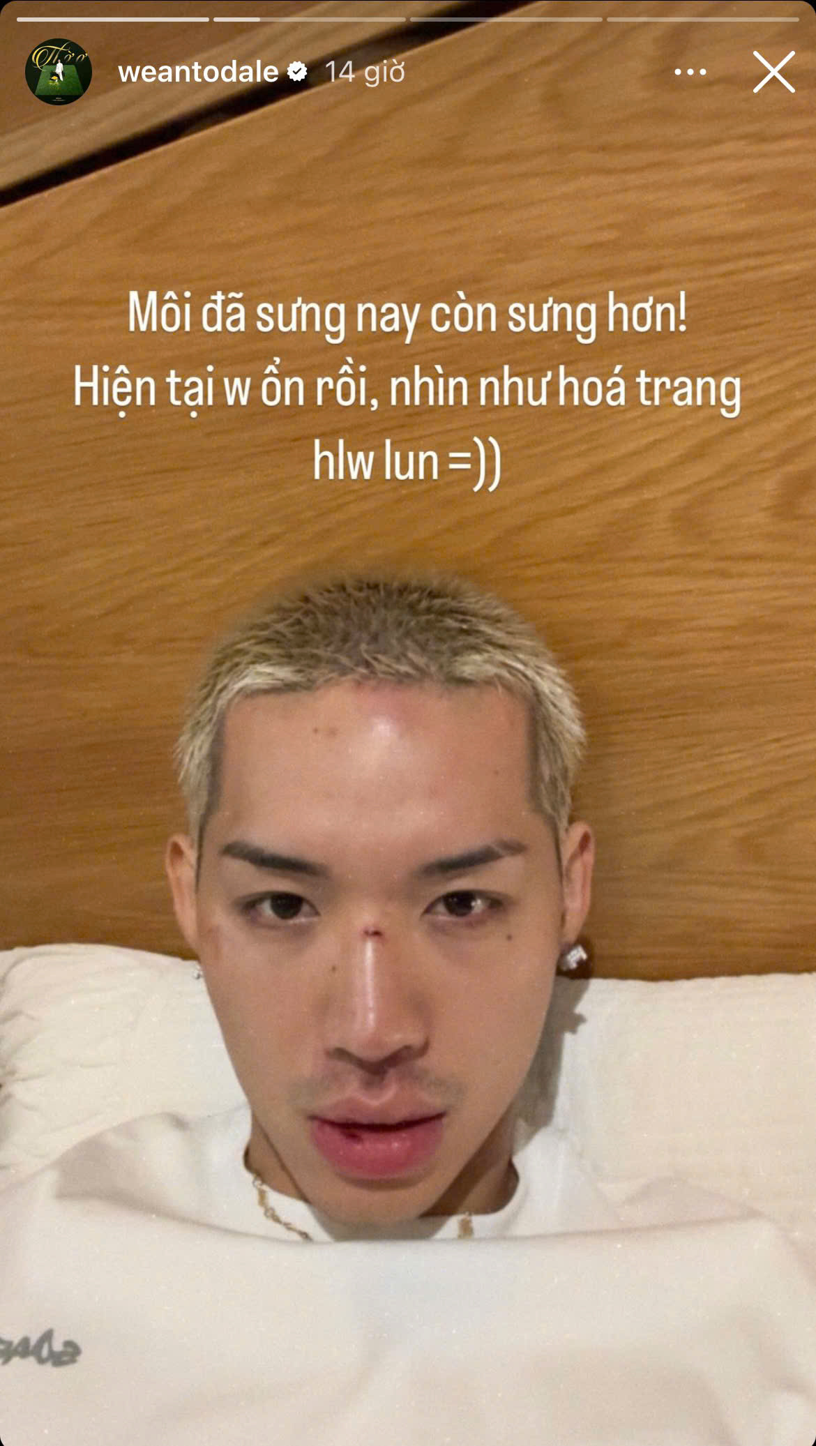 WEAN LE đùa rằng sự cố không mong muốn vô tình tạo “lớp trang điểm” hóa trang Halloween sớm và cho biết hiện tại bản thân đã ổn hơn. WEAN LE đùa rằng sự cố không mong muốn vô tình tạo “lớp trang điểm” hóa trang Halloween sớm và cho biết hiện tại bản thân đã ổn hơn.