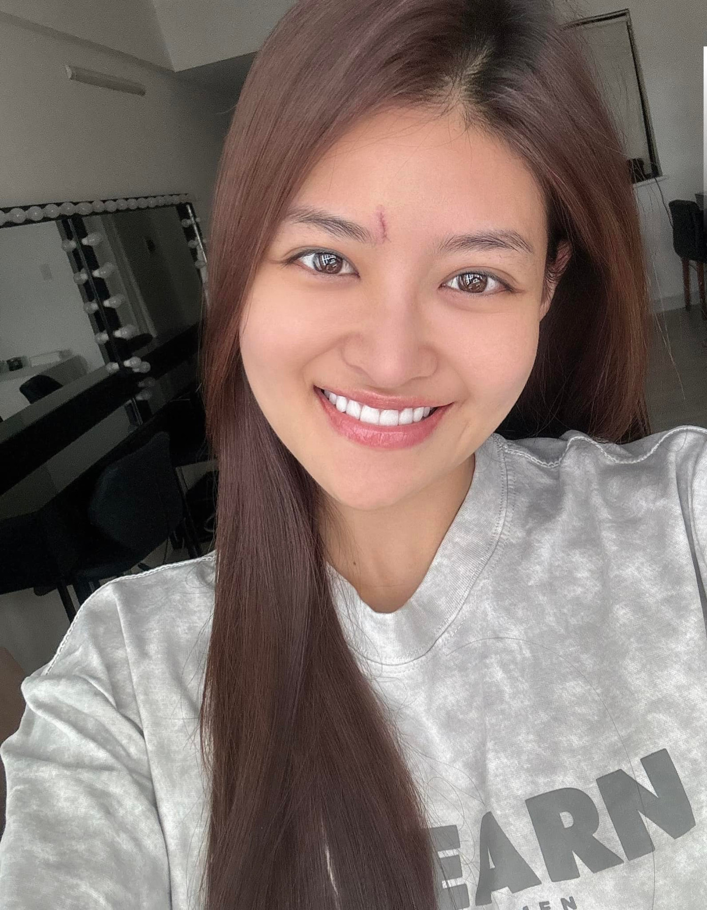 Thùy Anh cho biết hiện tại vết thương đã ổn hơn, cần kiêng ăn một số món.