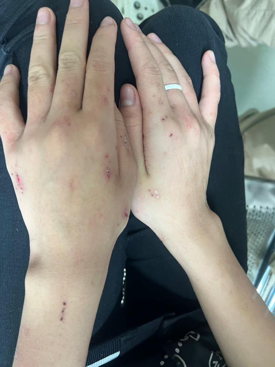 Một học sinh lớp 8 ở Hà Nội từng bị trầm cảm, có hành vi tự hành hạ bản thân. Ảnh: Hà Linh