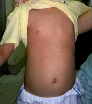 Bệnh nhi bị nổi ban dày đặc sau 2 ngày dùng thuốc tiêu độc. Ảnh: Trương Lâm.