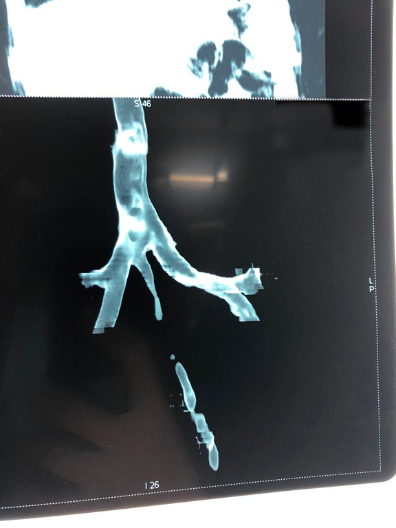 Bé gái 2 tháng tuổi mắc bệnh cực hiếm lần đầu phát hiện tại Việt Nam ảnh 1