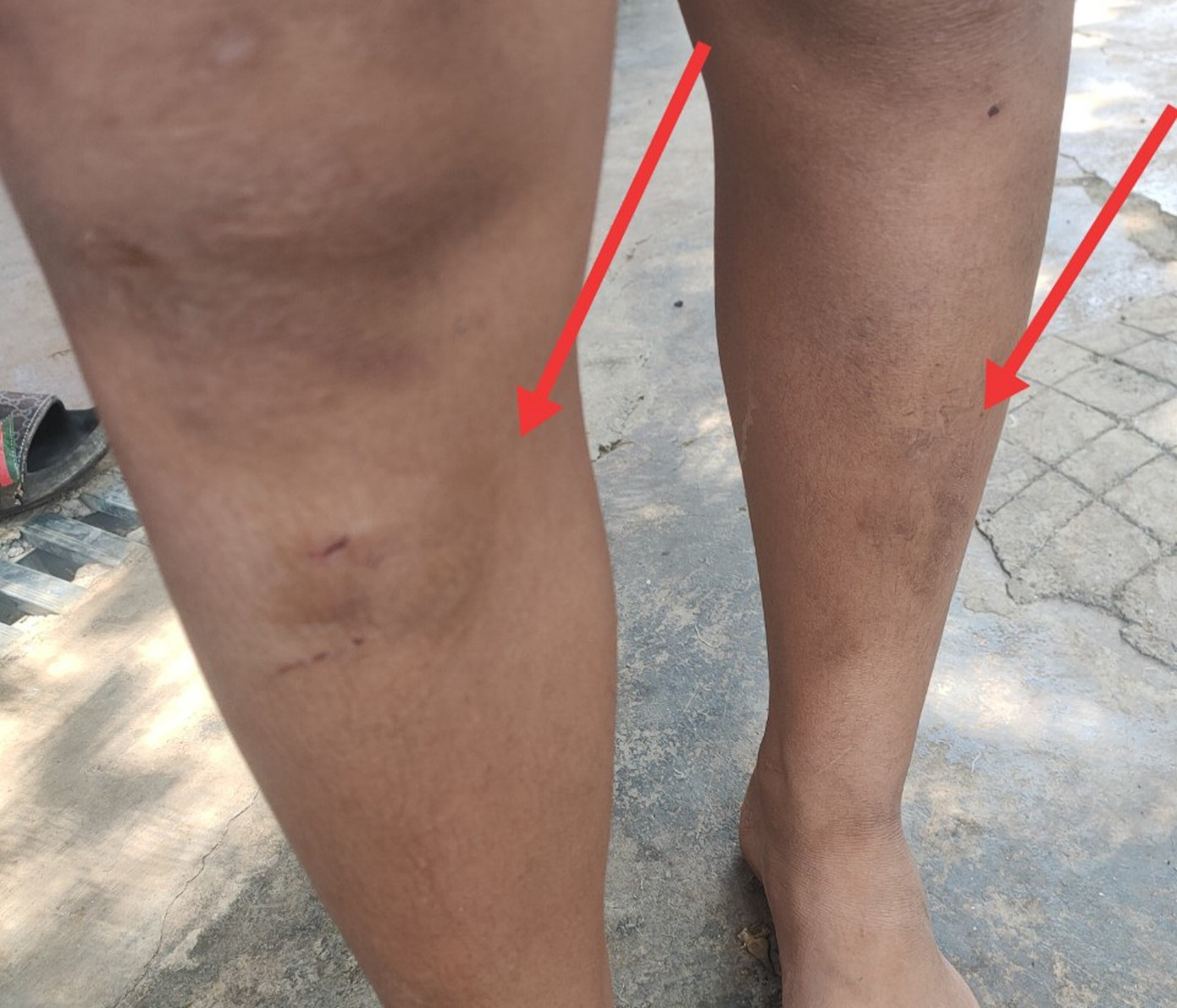 1 trong 5 cháu nhỏ bị mẹ con bà T. đánh vào chân