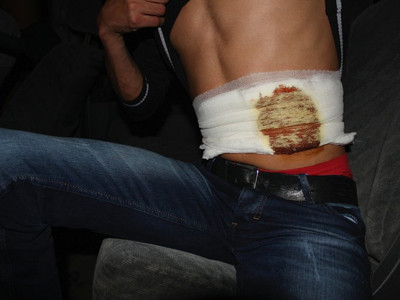 Raid mới đây bán thận ở Li-băng, vết thương vẫn chưa lành. Ảnh: Der Spiegel