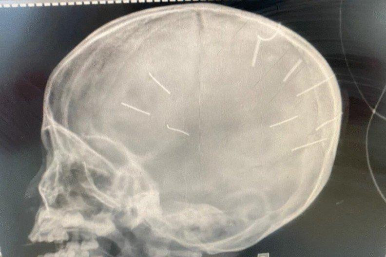 Hình ảnh hộp sọ của bé gái. Ảnh: Đ.X Hình ảnh hộp sọ của bé gái. Ảnh: Đ.X