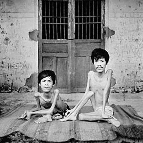 Những nạn nhân da cam luôn chờ những sự cảm thông sẻ chia (Nguồn: Internet)