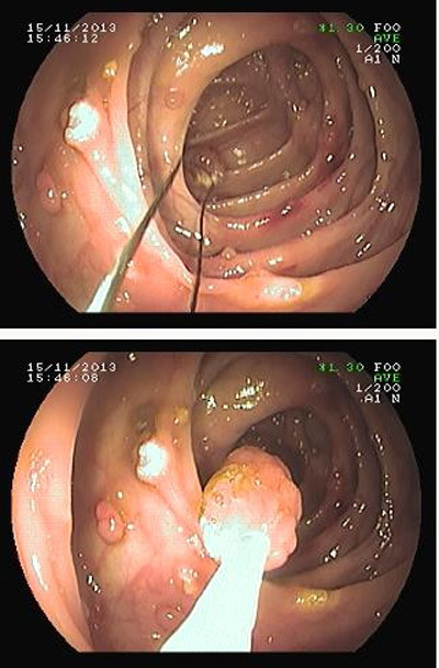 Các khối u lành nằm rải rác trong ruột già và đang được cắt bỏ qua nội soi ruột già (ảnh chụp trực tiếp qua máy nội soi- BS Lưu Phương). Các khối u lành nằm rải rác trong ruột già và đang được cắt bỏ qua nội soi ruột già (ảnh chụp trực tiếp qua máy nội soi- BS Lưu Phương)