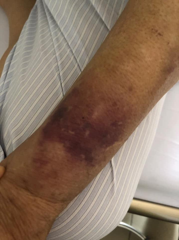 Hình ảnh cánh tay thâm tím vì lấy ven được nghệ sĩ Giang Còi chia sẻ vào ngày 7/6 khiến người hâm mộ không khỏi xót xa.