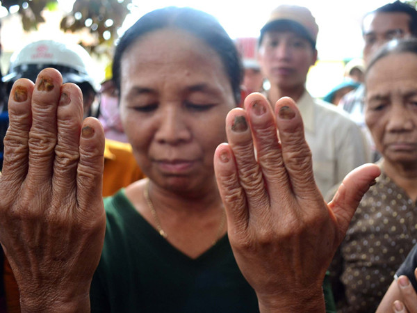 Đôi bàn tay của bà Võ Thị Có bị ăn hết móng được cho là do nước thải từ mỏ vàng đổ xuống tại ruộng rau của bà 