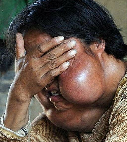 Cô Lý Hồng Phương, 40 tuổi, sống ở tỉnh Thiểm Tây, Trung Quốc, khuôn mặt cô bỗng dưng mọc lên những khối u lớn và biến dạng trầm trọng. Chúng cứ lớn dần, lớn dần và ngày càng đáng sợ