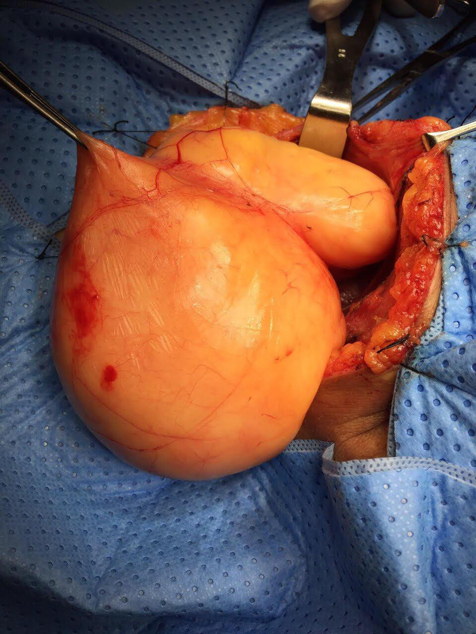 Túi bướu ở cổ bệnh nhân D nặng gần 1kg