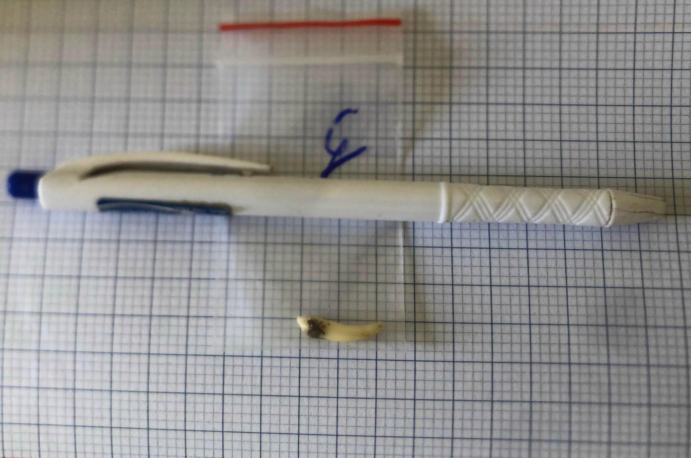 Chiếc răng mọc ngược được lấy từ hốc mũi bệnh nhân