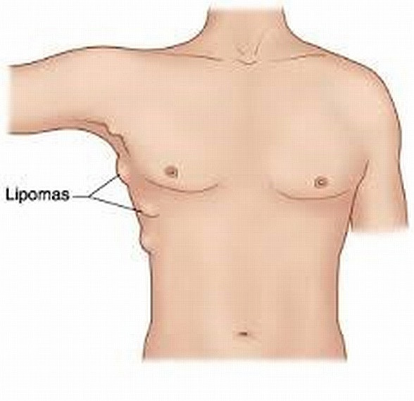  Lipomas (u mỡ) là các khối u dưới da lành tính, dễ dàng nhận ra vì mềm mại, tròn. Chúng thường xuất hiện ở cổ, các chi hay bất cứ nơi nào trên cơ thể