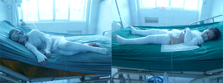 Hai cháu Quỳnh Trang và Quỳnh Anh đang nằm điều trị tại Khoa hồi sức cấp cứu - Viện Bỏng quốc gia. Ảnh: Tuấn Nguyễn