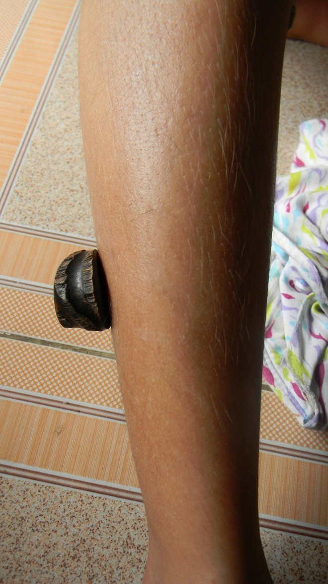 Cục sừng dính chặt trên vết thương. Cục sừng dính chặt trên vết thương