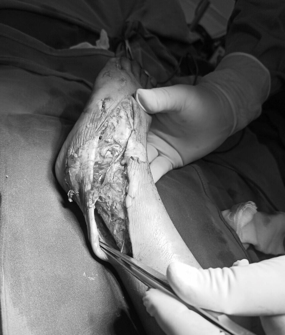 Các bác sĩ thực hiện ghép da tự thân cho trẻ - Ảnh: Bác sỹ cung cấp