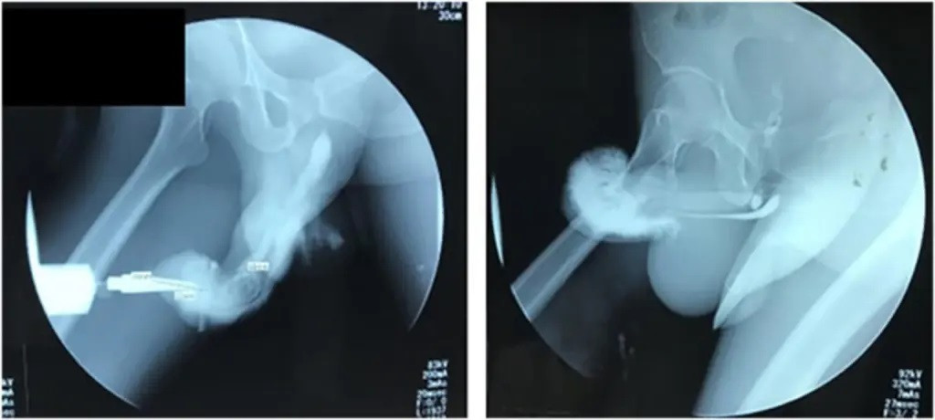 Ảnh chụp X-quang cho thấy dương vật bị gãy của một người đàn ông Indonesia khác từ tháng 7 năm 2022. Nguồn:Tạp chí Phẫu thuật Quốc tế