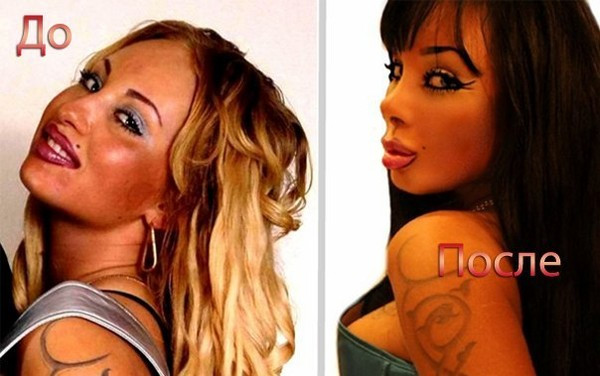 Alyona trước và sau thẩm mỹ