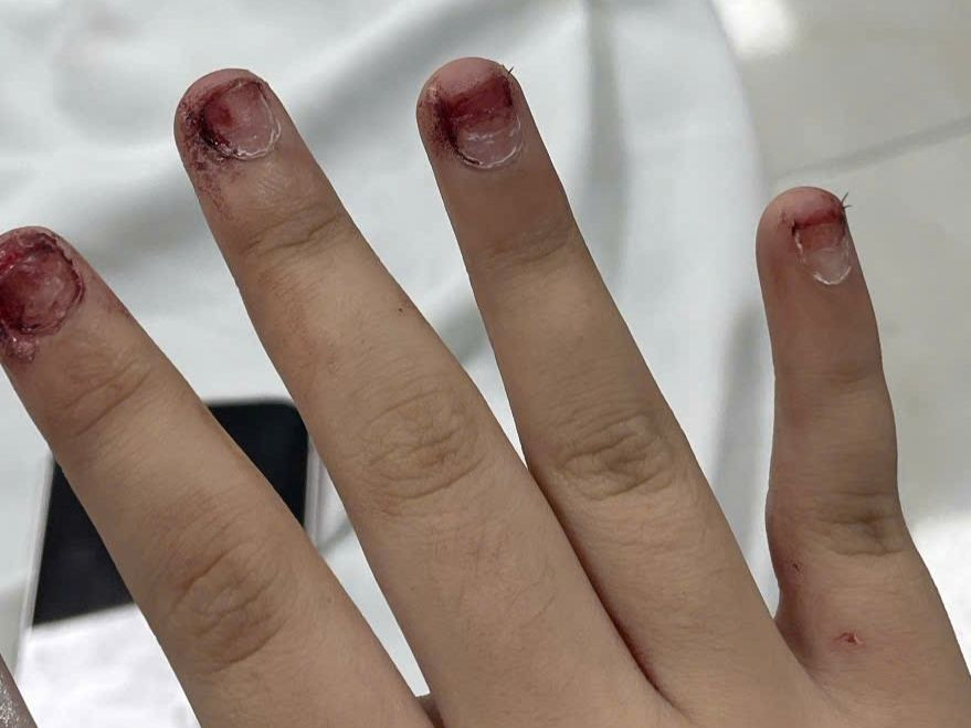 Thương tích trên người nữ sinh sau khi bị đánh.