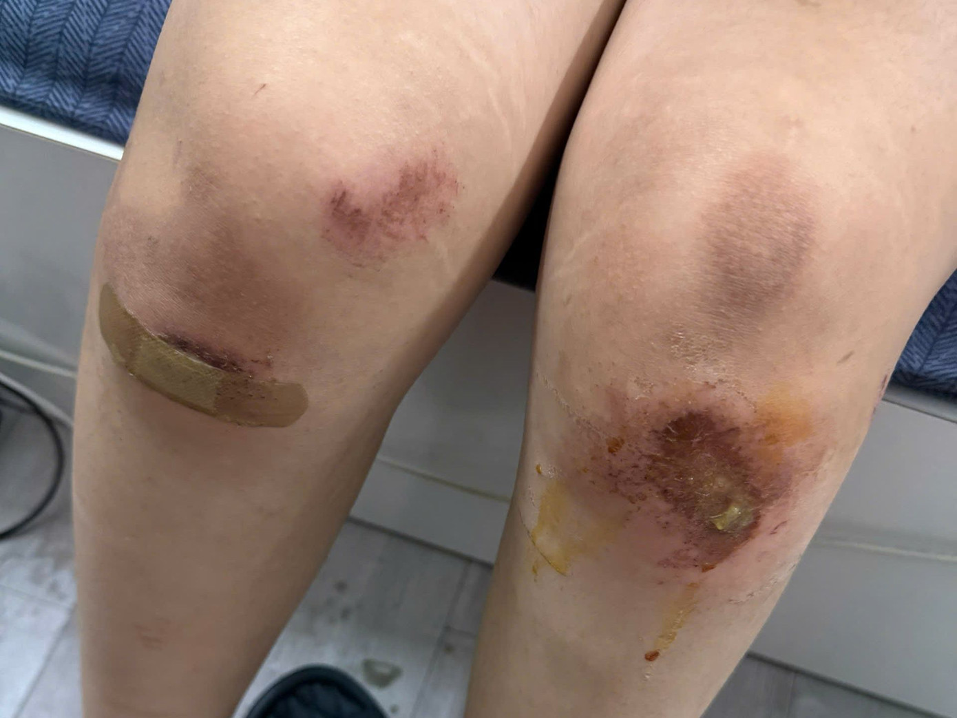 Thương tích trên người nữ sinh sau khi bị đánh.