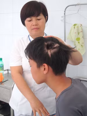 Đầu Tú bị lõm sâu do chưa được ghép lại nguyên vẹn hộp sọ