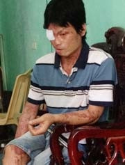 Anh Sơn nạn nhân của vụ tạt axít