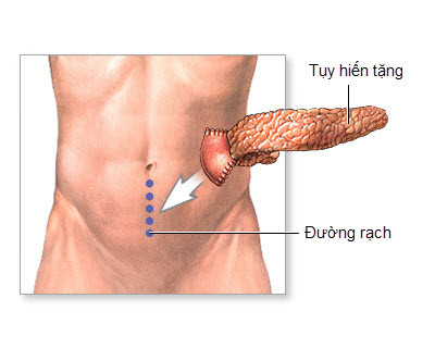 Hy vọng mới cho bệnh nhân tiểu đường