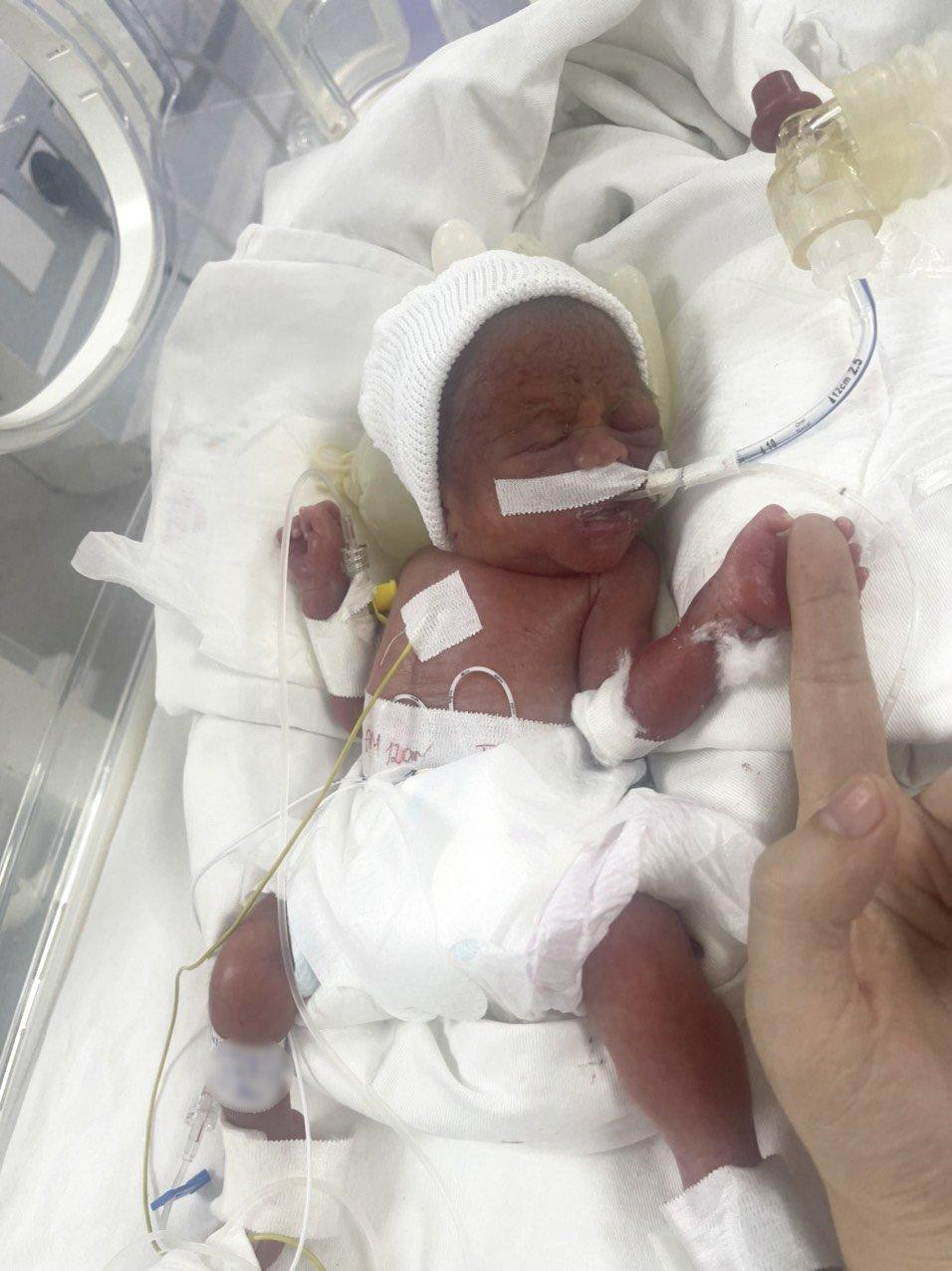 Bé khi vừa sinh đang được cấp cứu tích cực. Ảnh: BV cung cấp