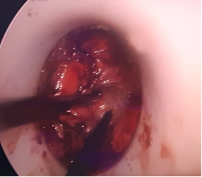 Hình ảnh phẫu thuật TaTME Hình ảnh phẫu thuật TaTME