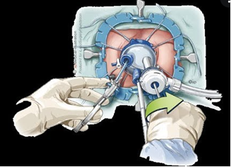 Hình ảnh phẫu thuật TaTME Hình ảnh phẫu thuật TaTME