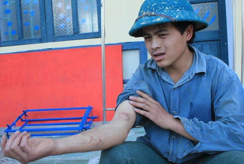 Đi làm “chui” ở Trung Quốc, Vừ Mí Phừ đã bị đánh đến độ mang đầy thương tích. Ảnh: Thái Hà