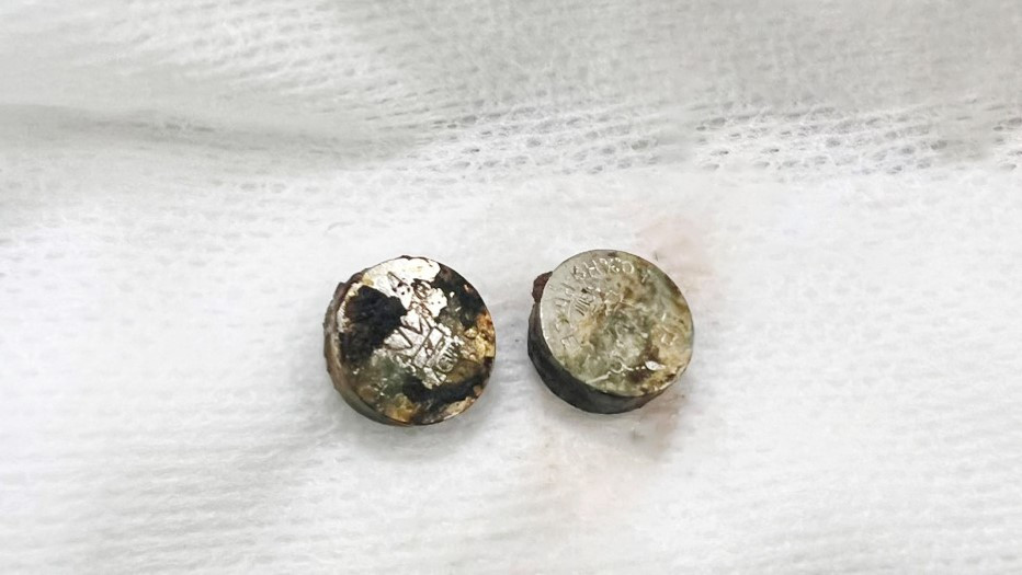 Dị vật là cục pin nằm trong mũi bé gái 6 tuổi.