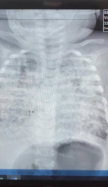 Bé trai 5 tháng tuổi phổi trắng xóa vì nhiễm lao từ cha ảnh 1