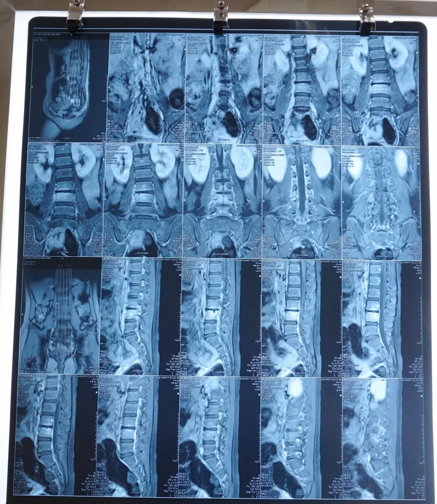 Đùa giỡn va cột sống vào cạnh bàn, bé gái suýt chết vì căn bệnh hiếm gặp ảnh 1