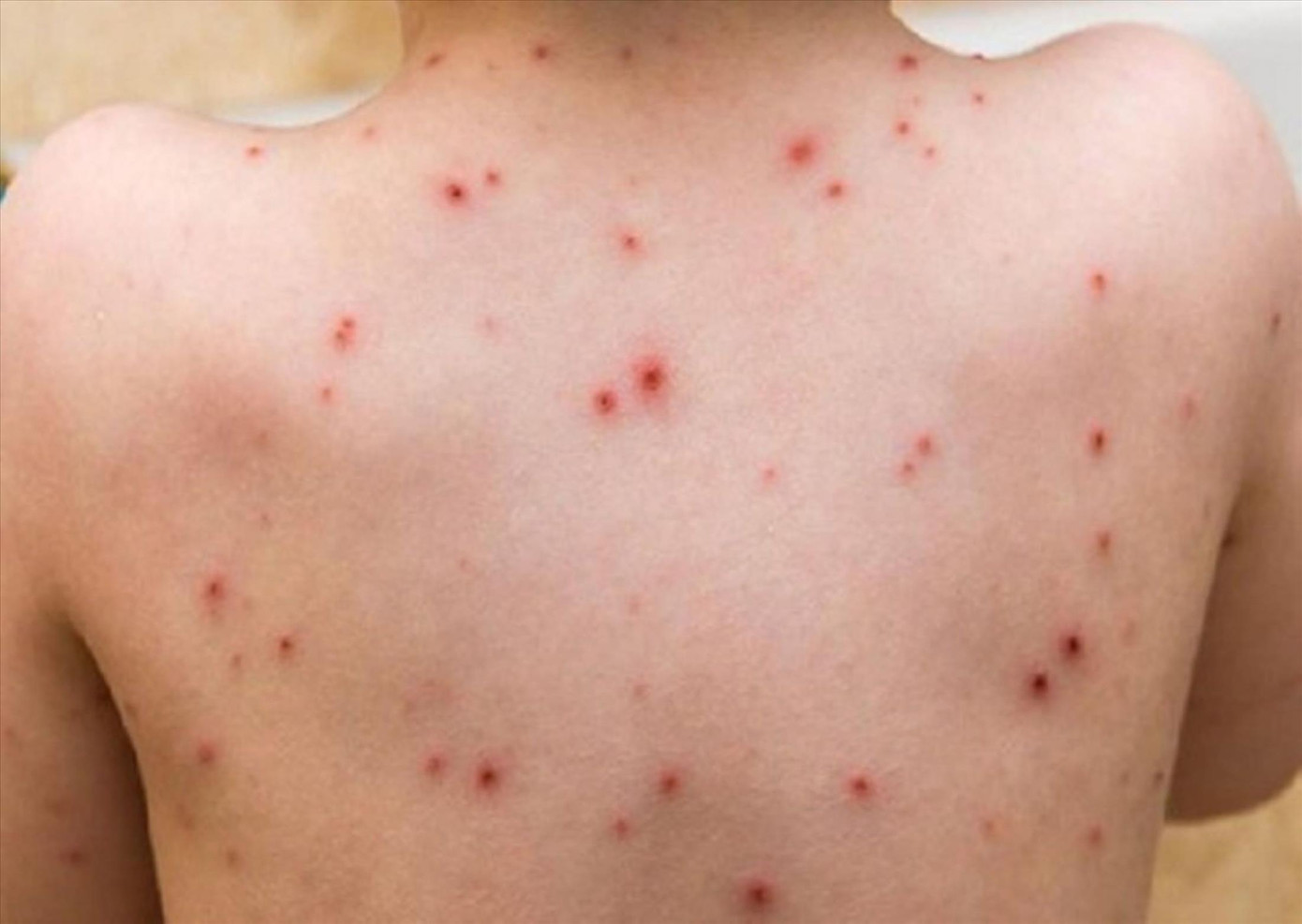 Bệnh đậu mùa khỉ có nguy cơ cao xâm nhập vào Việt Nam Bệnh đậu mùa khỉ có nguy cơ cao xâm nhập vào Việt Nam