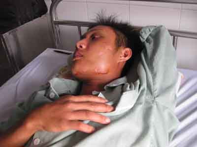 Một nạn nhân bị băng nhóm Dũng Phương đánh phải nhập viện