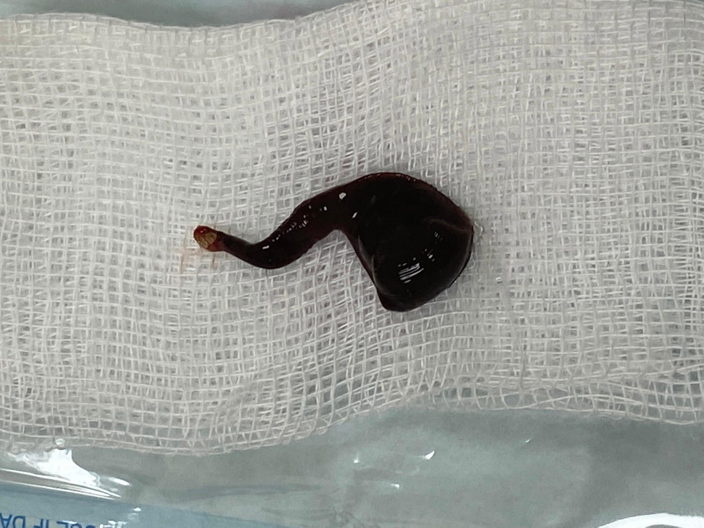 Con đỉa dài khoảng 5cm ký sinh trong mũi nam bệnh nhân.