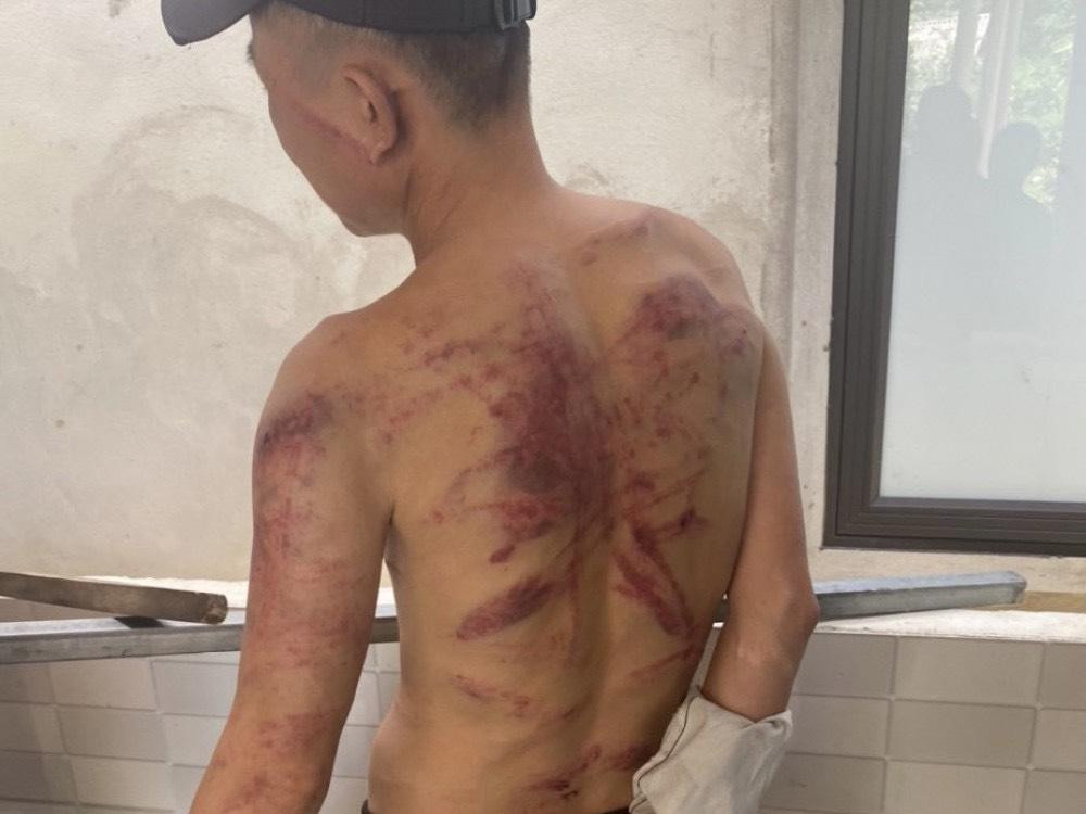 Do không có tiền trả nợ, anh H. bị Hiền dùng dây điện đánh bầm tím người. Do không có tiền trả nợ, anh H. bị Hiền dùng dây điện đánh bầm tím người.