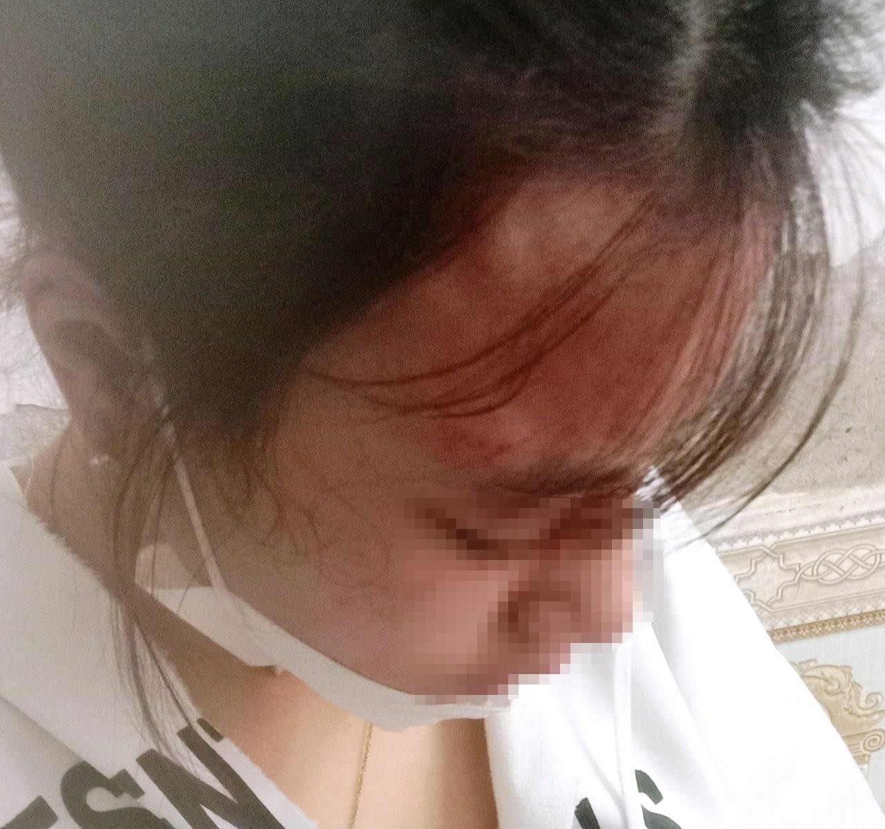 Em L. bị đánh chấn động não, thương tích 6%. (Ảnh gia đình cung cấp).